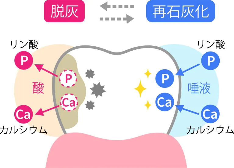 むし歯の原因｜郡山で予防歯科なら郡山ラポール歯科